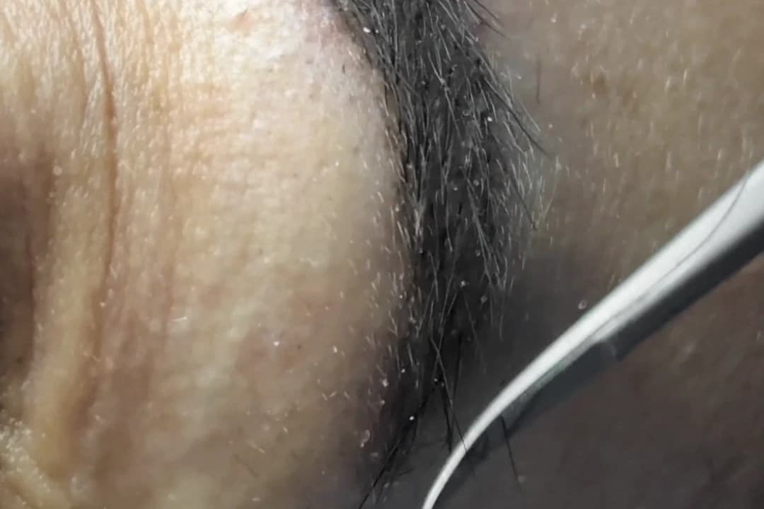 The nanoneedle implanting a fibre along the line of the eyebrow.