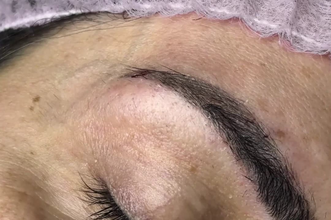 An eyebrow after treatment, close up, with the implanted fibres following the natural line.