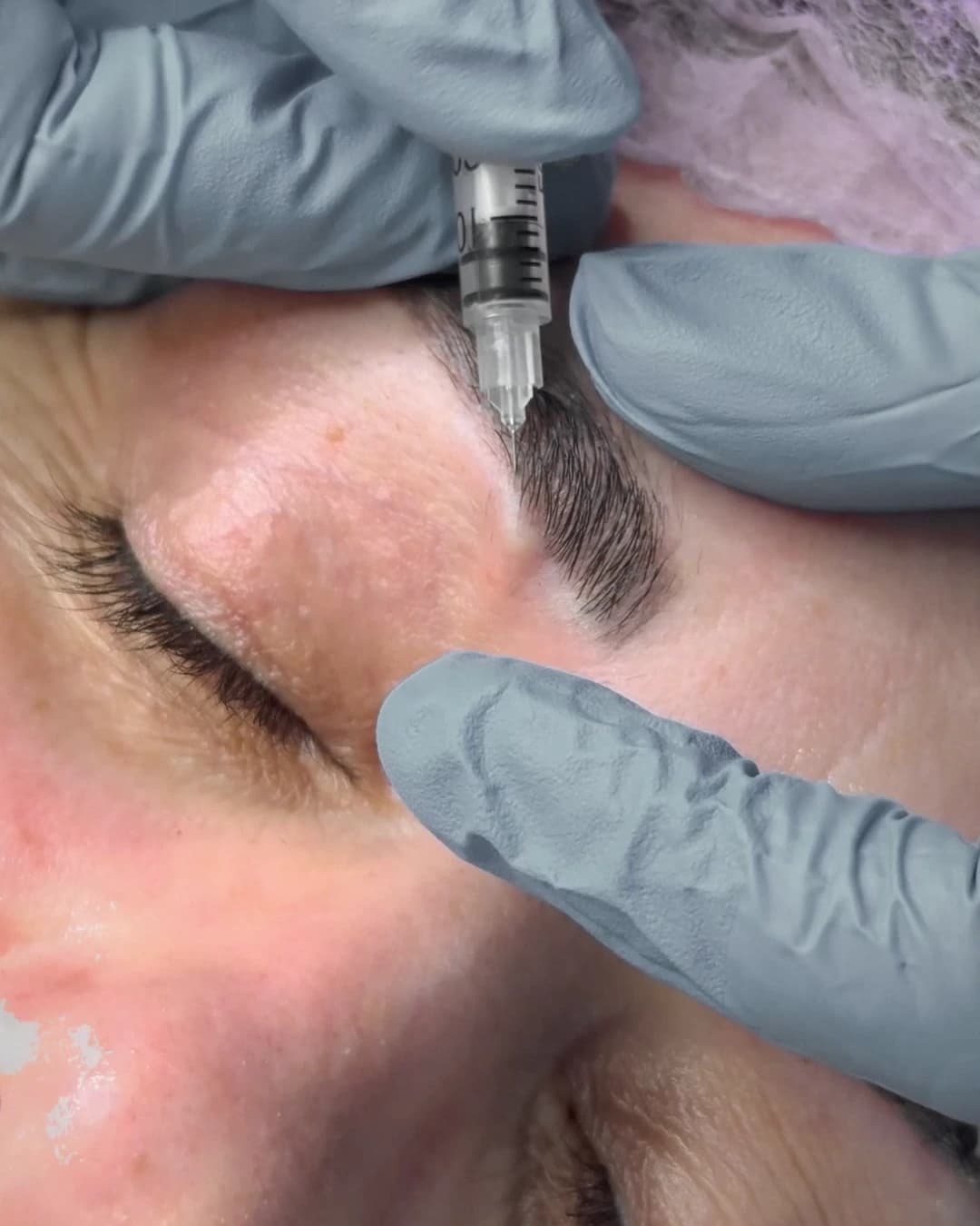 The moment a fibre is implanted, seen close up.